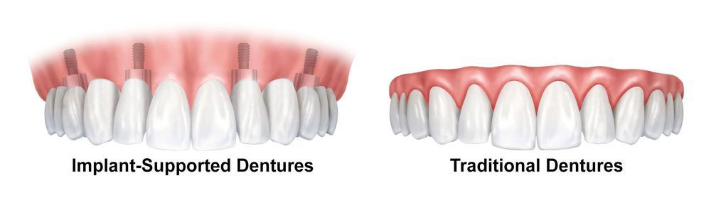 dentures