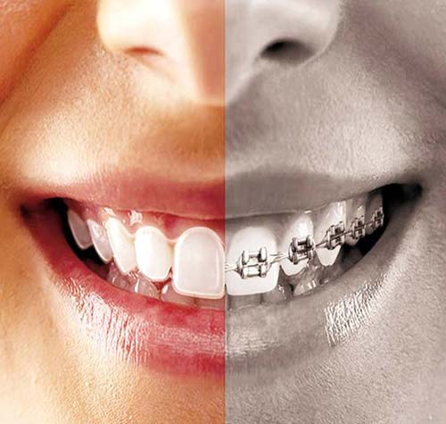Orthodontics and Invisible Braces
