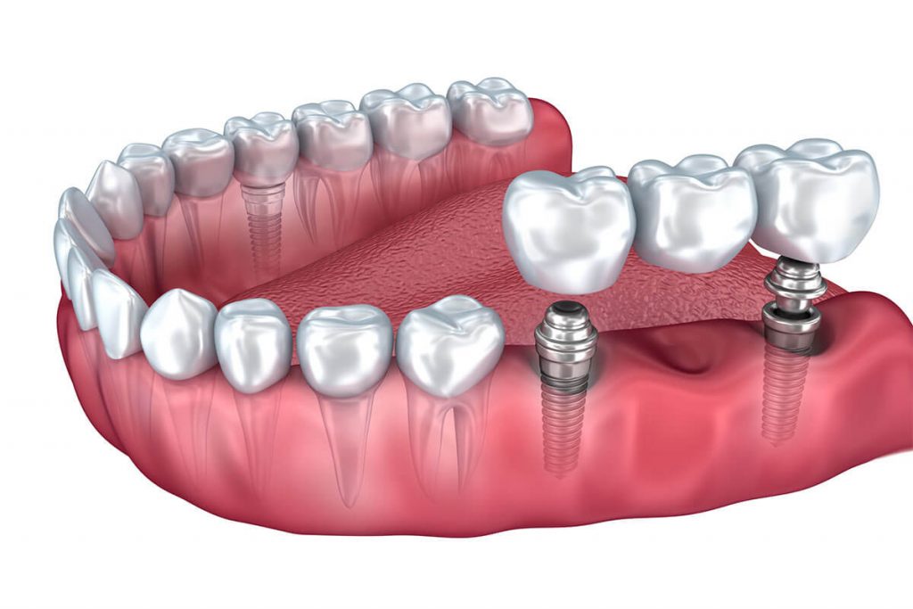 dental bridges