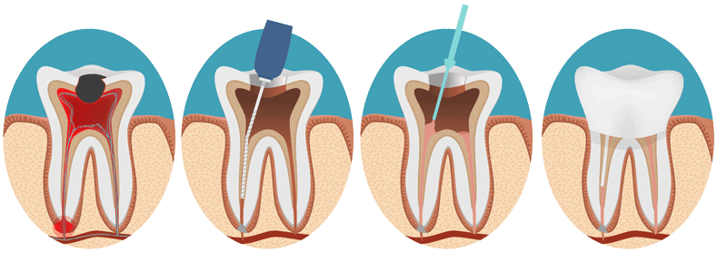 root canal