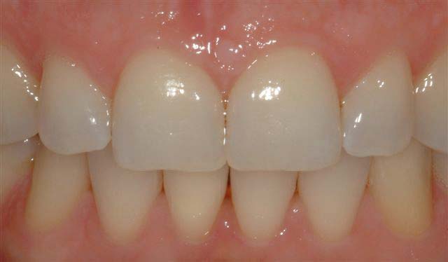 Tooth-Whitening 04