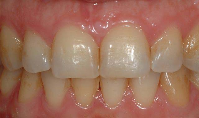 Tooth-Whitening 01