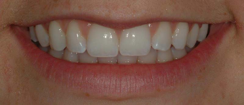 Tooth-Whitening 02