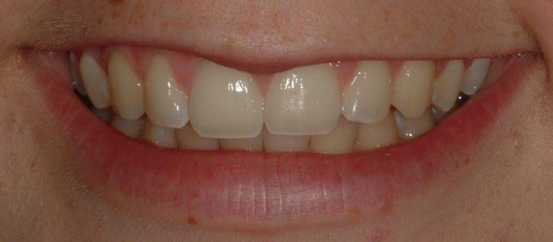 Tooth-Whitening 03
