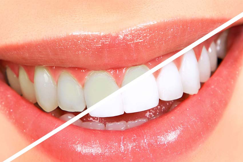 Tooth-Whitening poster