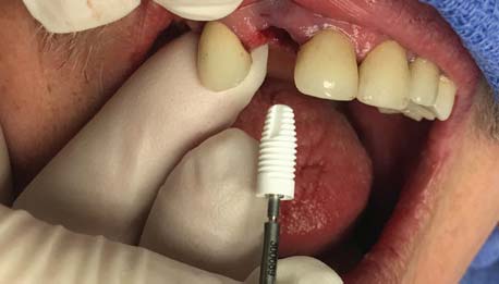 Zirconia-Dental-Implants