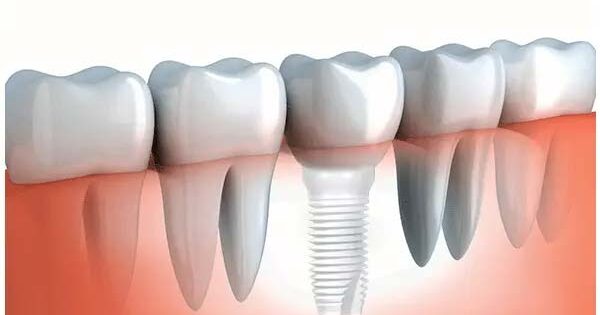 Zirconia-Dental-Implants