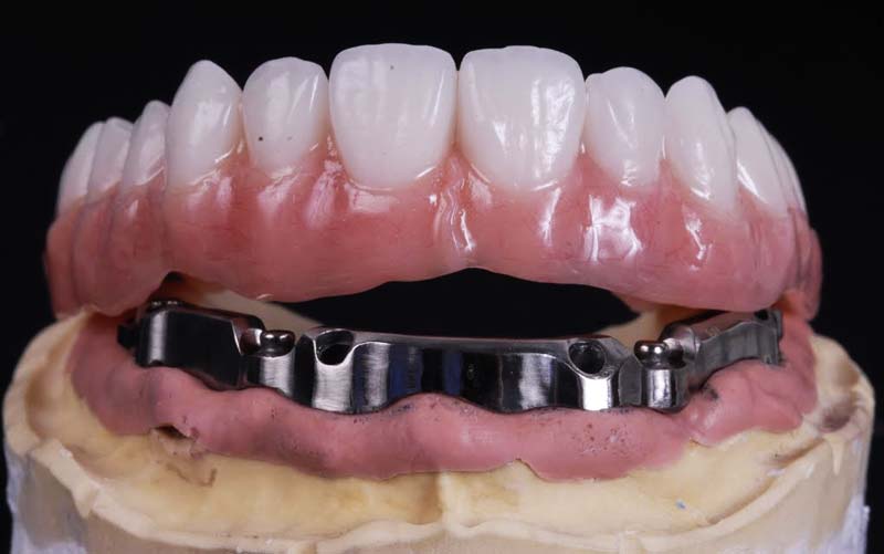 IMPLANT SUPPORTED PROSTHESIS WITH A MILLED BAR ATTACHMENT