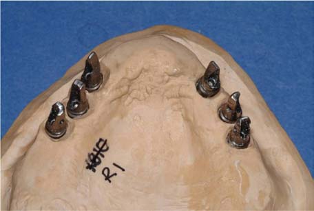 Implant-Supported-Bridge-with-Individually-Cemented-Crowns-on-Superstructure 01