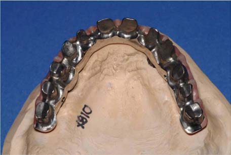 Implant-Supported-Bridge-with-Individually-Cemented-Crowns-on-Superstructure 02