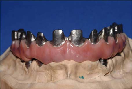 Implant-Supported-Bridge-with-Individually-Cemented-Crowns-on-Superstructure 03