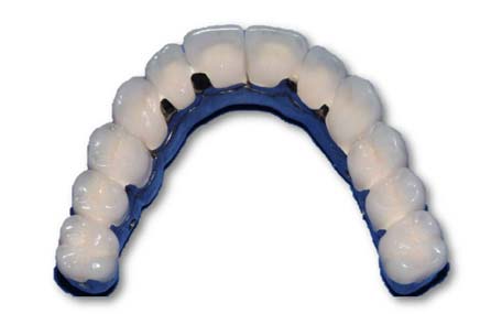 Implant-Supported-Bridge-with-Individually-Cemented-Crowns-on-Superstructure 05