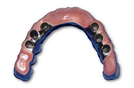 Implant-Supported-Bridge-with-Individually-Cemented-Crowns-on-Superstructure 06