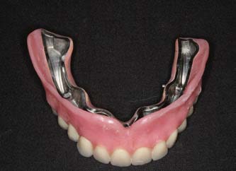 Implant-Supported-Prosthesis-with-Milled-Bar 03