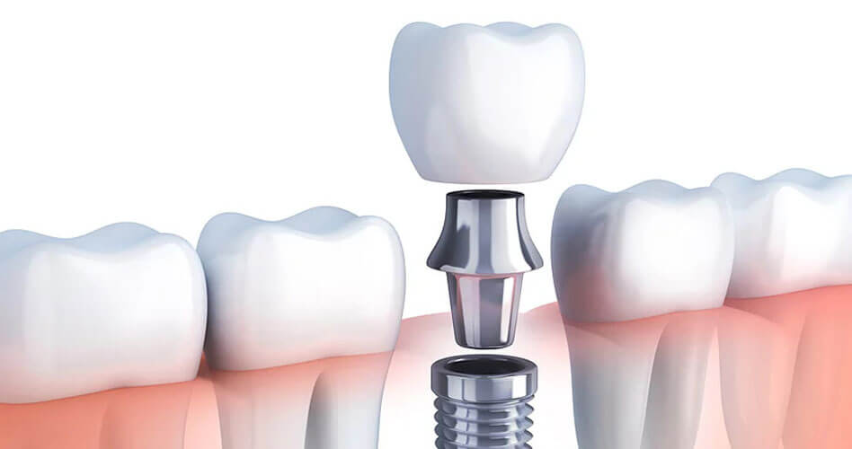 IMPLANT SUPPORTED CROWN