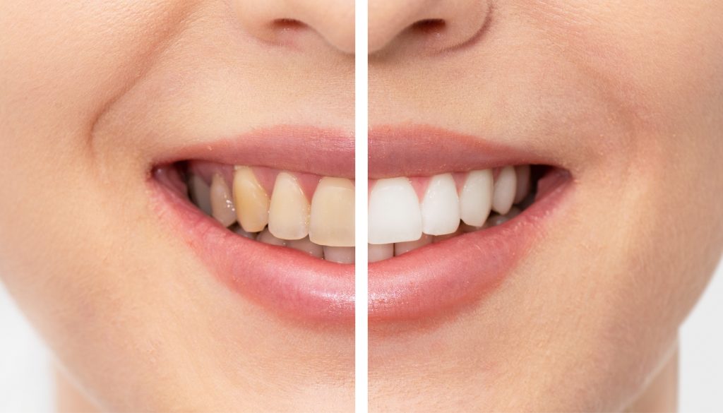 Before and after results of professional Teeth Whitening in Barnet at Mona Lisa Clinic.