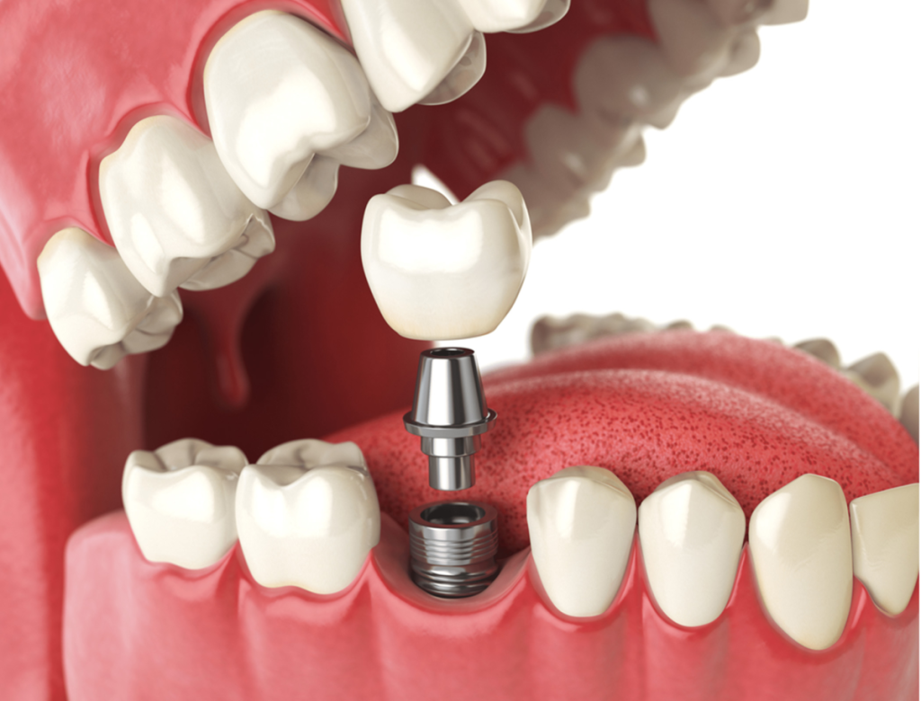 Advanced Dental Implants in Barnet