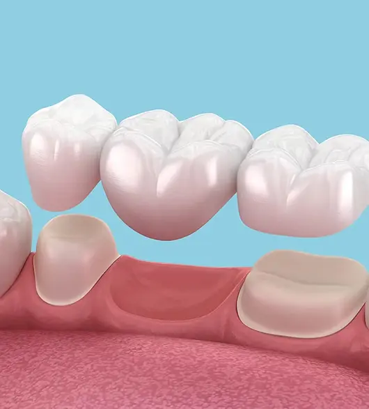 3D model of a dental bridge fitting over two prepared teeth, one of the restorations reviewed at a dental check-up