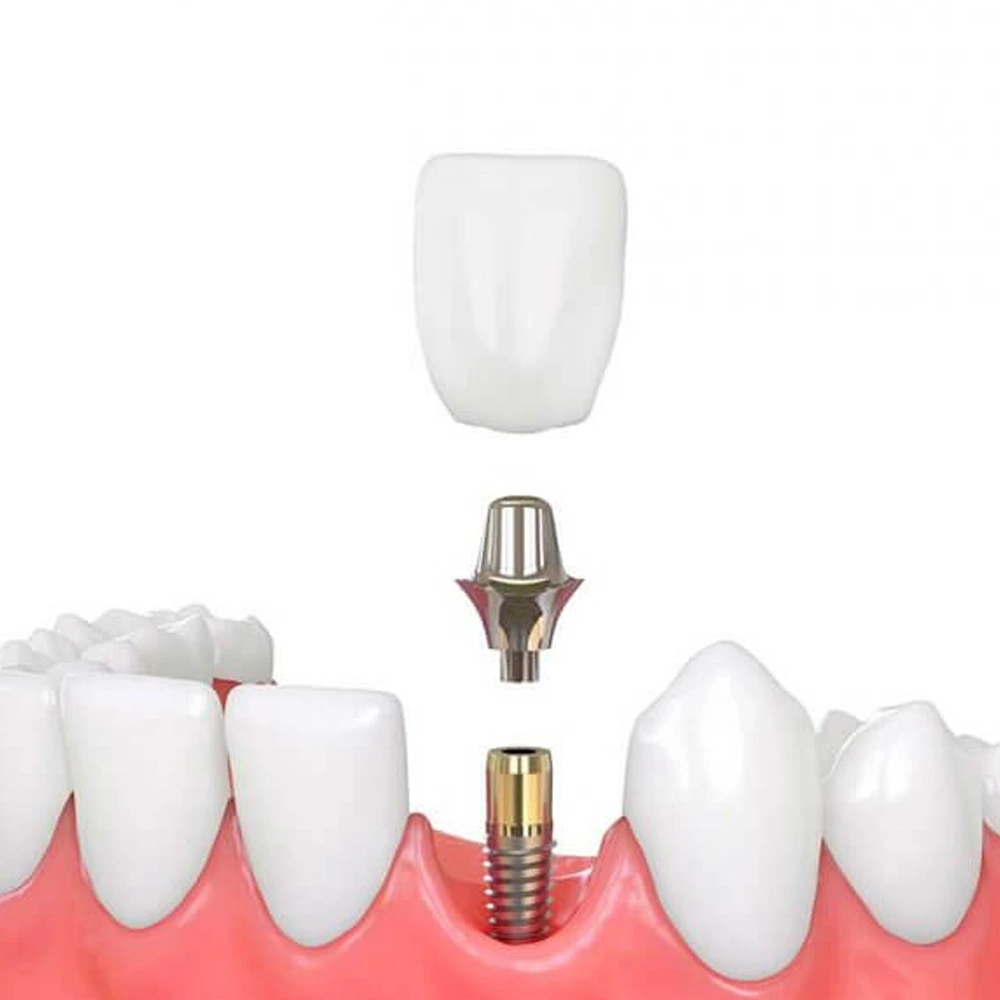 Implant crown attached to an abutment and dental implant between natural teeth