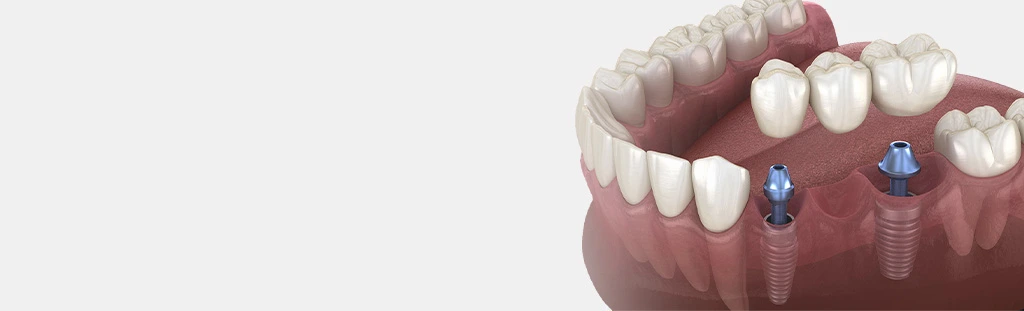 3D model of an implant bridge being fitted onto a dental implant and abutment in the lower jaw