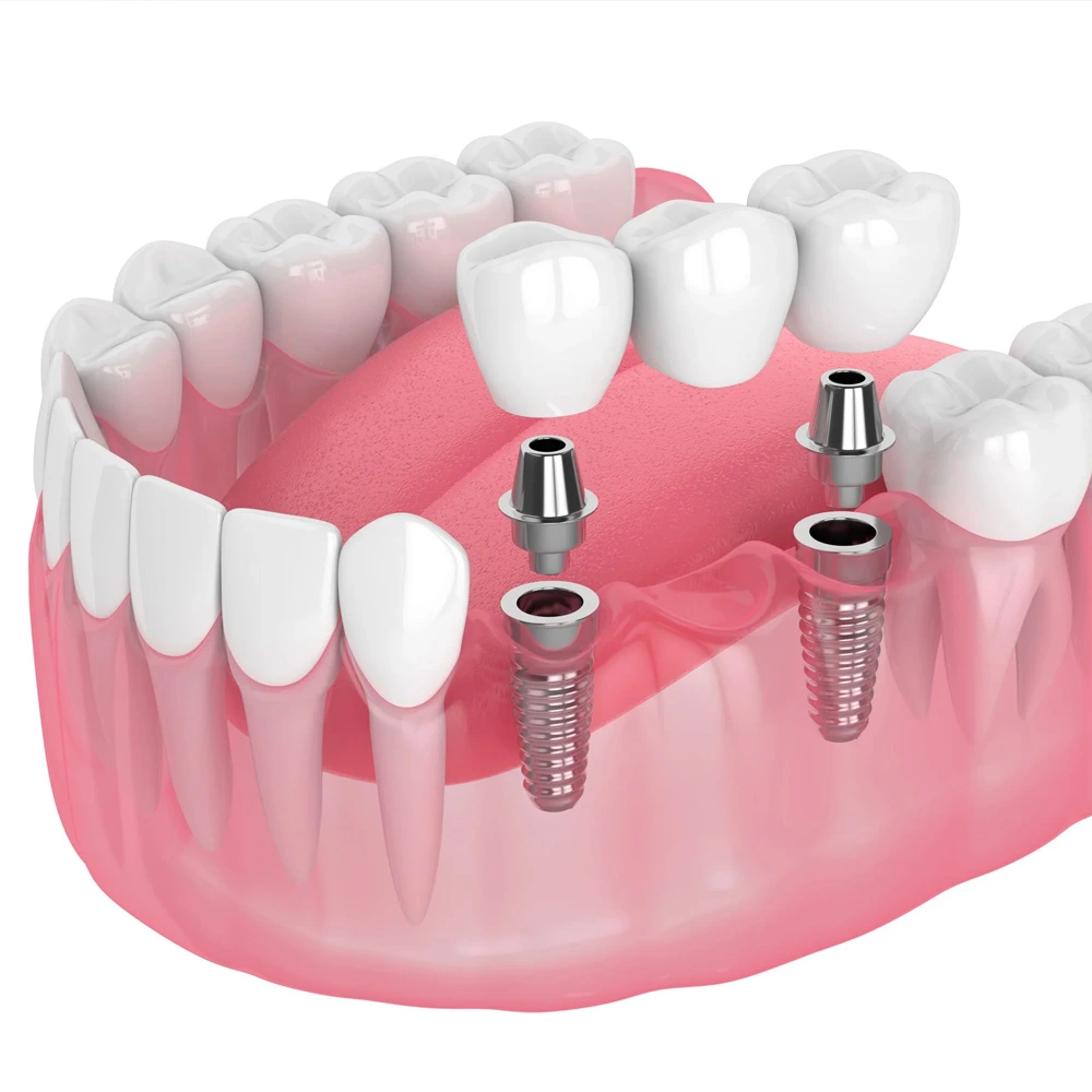 Implant-supported bridge replacing several missing teeth in a row