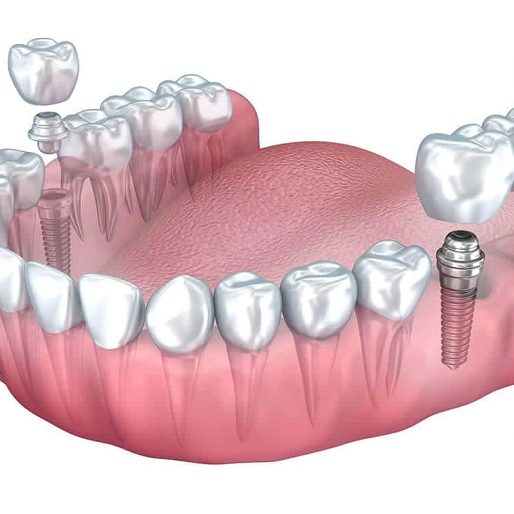Close-up of a smiling patient's teeth at Mona Lisa Smiles in New Barnet