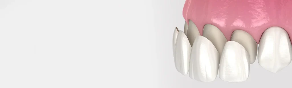 3D illustration of healthy upper teeth and gums, as examined at a routine dental check-up in Barnet